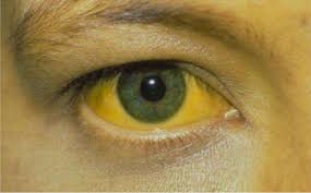 Жёлтая лихорадка